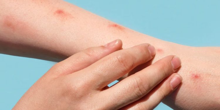 Fundação registra redução de casos de mpox no Amazonas