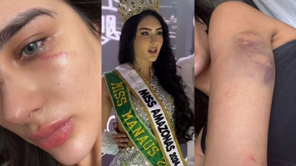 'Deu murros na cara’: Miss Manaus denuncia ex-companheiro e mostra marcas pelo corpo