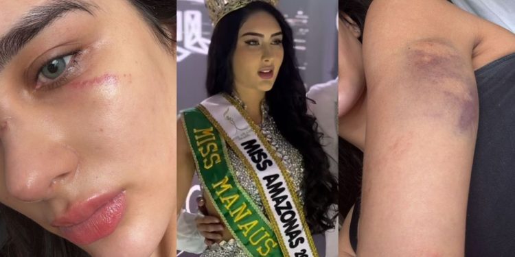 'Deu murros na cara’: Miss Manaus denuncia ex-companheiro e mostra marcas pelo corpo