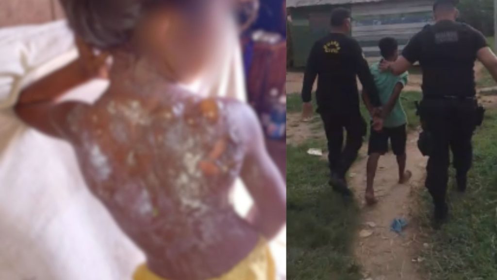 Vídeo: Padrasto joga mingau quente e queima costas de menina de 6 anos em Autazes