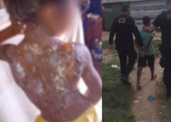 Vídeo: Padrasto joga mingau quente e queima costas de menina de 6 anos em Autazes