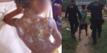 Vídeo: Padrasto joga mingau quente e queima costas de menina de 6 anos em Autazes