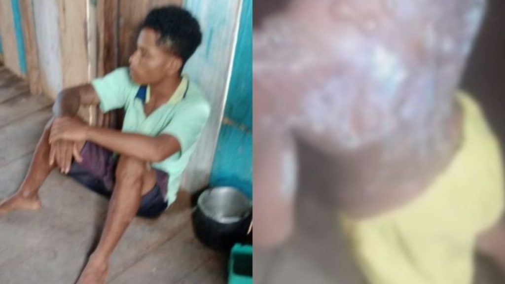 Investigação aponta motivo de padrasto ter queimado as costas da enteada de 6 anos em Autazes