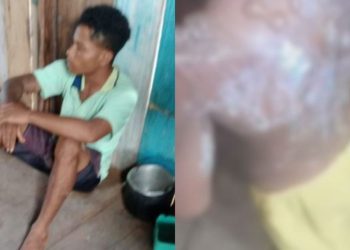 Investigação aponta motivo de padrasto ter queimado as costas da enteada de 6 anos em Autazes