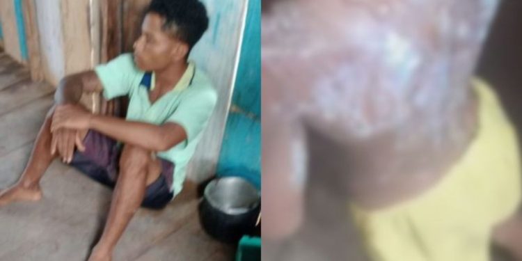Investigação aponta motivo de padrasto ter queimado as costas da enteada de 6 anos em Autazes