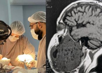 Homem retira tumor de 2 kg da mandíbula em Manaus