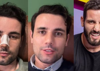 Ex-BBB Matteus refaz o nariz para melhorar a lataria: ‘eu tinha uma batata largona’