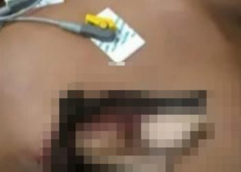 Cena forte: jovem é perfurad0 por madeira ao c0rtar árvore no Amazonas