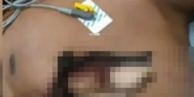 Cena forte: jovem é perfurad0 por madeira ao c0rtar árvore no Amazonas