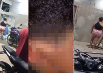 Veja como ficou menino de 9 anos queimad0 com água fervendo por vizinha no Amazonas