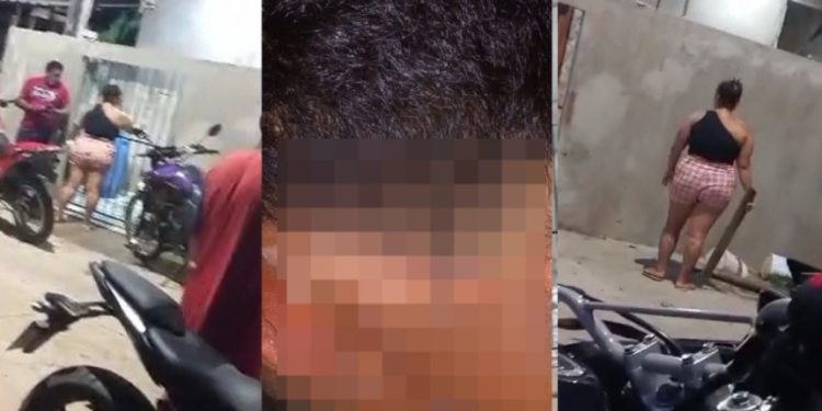 Veja como ficou menino de 9 anos queimad0 com água fervendo por vizinha no Amazonas
