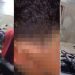 Veja como ficou menino de 9 anos queimad0 com água fervendo por vizinha no Amazonas