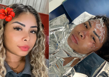 Industriária grávida f3r1da em incêndio no Distrito Industrial 2 continua internada