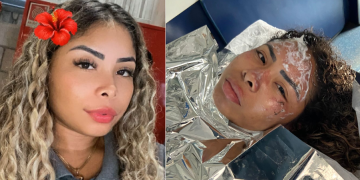 Industriária grávida f3r1da em incêndio no Distrito Industrial 2 continua internada