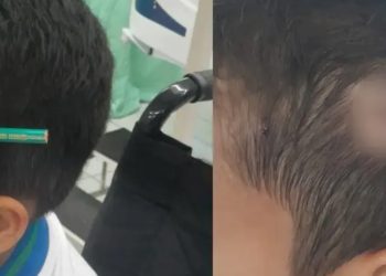 Coleguinha crava lápis na cabeça de aluno de 9 anos na escola