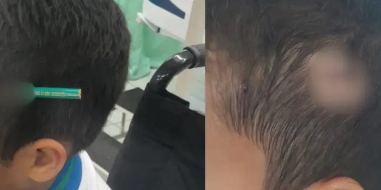 Coleguinha crava lápis na cabeça de aluno de 9 anos na escola