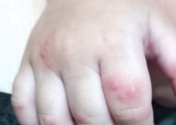 Mão-pé-boca: FVS reforça cuidados contra a doença no Amazonas