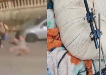 Em Manaus, mulher bale4d4 por sargento no braço e tórax passa por cirurgia e segue estável