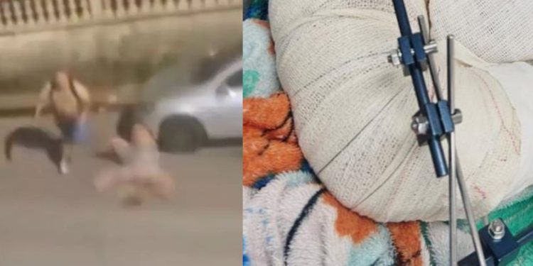Em Manaus, mulher bale4d4 por sargento no braço e tórax passa por cirurgia e segue estável
