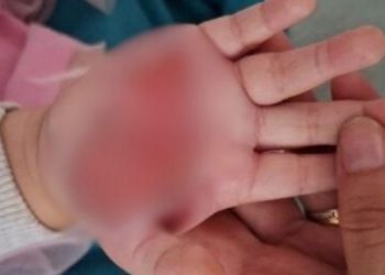 Pai aciona polícia após esposa dele queimar a mão da filha de 2 anos com colher quente