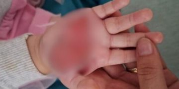 Pai aciona polícia após esposa dele queimar a mão da filha de 2 anos com colher quente