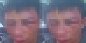 Imagem forte: jovem tem rosto desfigurad0 pelo vizinho em Manaus