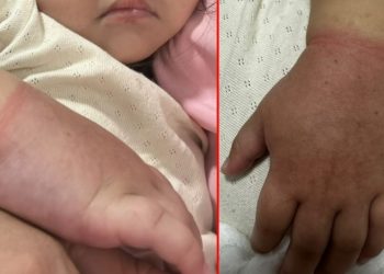 Menina de 2 anos quase perde braço por prender elástico de cabelo no braço em Manaus 