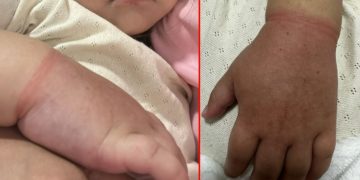 Menina de 2 anos quase perde braço por prender elástico de cabelo no braço em Manaus 