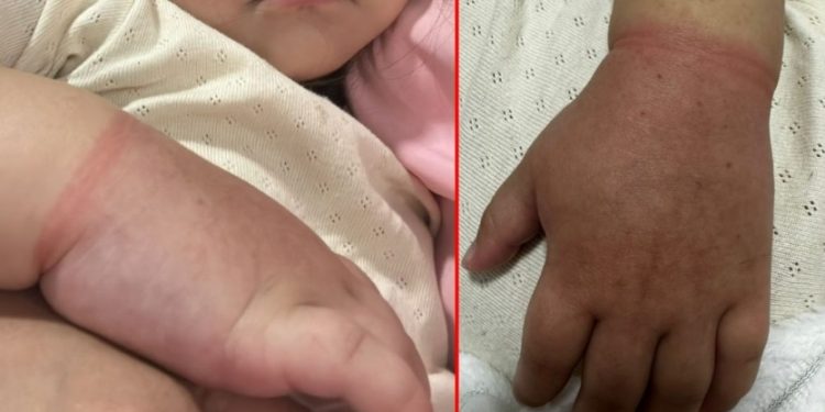 Menina de 2 anos quase perde braço por prender elástico de cabelo no braço em Manaus 