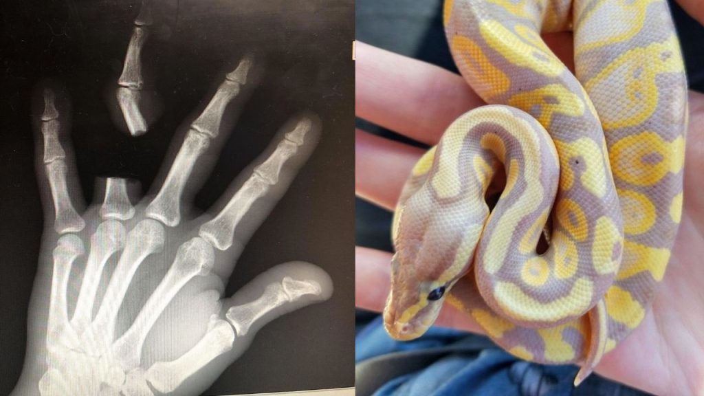 Em ato de desespero, idoso se mutil4 após picada de cobra; médicos informam que espécie não era letal