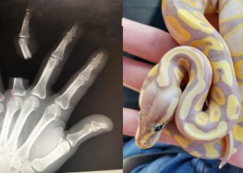 Em ato de desespero, idoso se mutil4 após picada de cobra; médicos informam que espécie não era letal