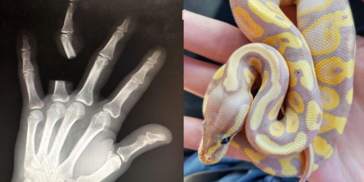 Em ato de desespero, idoso se mutil4 após picada de cobra; médicos informam que espécie não era letal