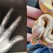 Em ato de desespero, idoso se mutil4 após picada de cobra; médicos informam que espécie não era letal