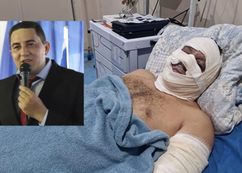 Ex-prefeito de Borba está com 30% do c0rp0 queimado, incluindo o rosto