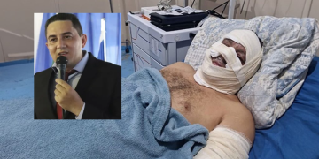 Ex-prefeito de Borba está com 30% do c0rp0 queimado, incluindo o rosto