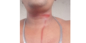 No Educandos, jovem quase tem o pescoço ‘t0rad0’ por linha de papagaio