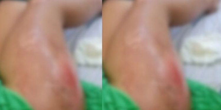 Mulher pede o divórcio e marido passa caminhão por cima da perna dela no Amazonas
