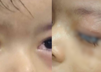 Menino usa cola industrial da mãe artesã e fica com os olhos colados em Parintins