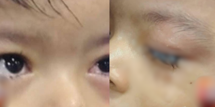 Menino usa cola industrial da mãe artesã e fica com os olhos colados em Parintins