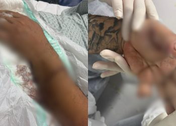 Em Manaus, motorista de app perde dedo após passageiro atacá-lo com terçad0 e pit bull