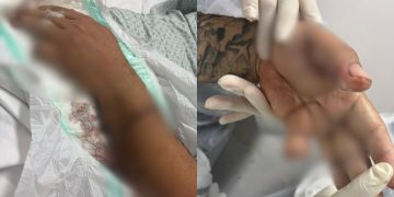 Em Manaus, motorista de app perde dedo após passageiro atacá-lo com terçad0 e pit bull