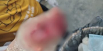 Em Tefé, mulher atinge a mão em lâmina de triturador enquanto cevava mandioca; veja