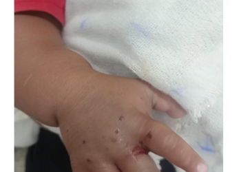 Bebê picad0 por cobra no interior do Amazonas é transferido para Manaus e família pede doações