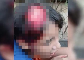 Vídeo forte: menina tem parte do couro cabeludo arrancado por motor de barco