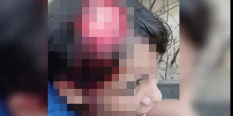 Vídeo forte: menina tem parte do couro cabeludo arrancado por motor de barco