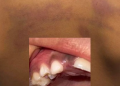 Menino perde o dente após ser agr3did0 pela própria mãe no AM, diz Conselho Tutelar
