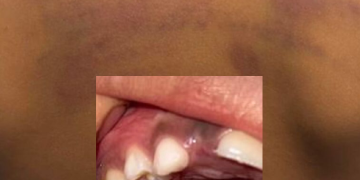 Menino perde o dente após ser agr3did0 pela própria mãe no AM, diz Conselho Tutelar