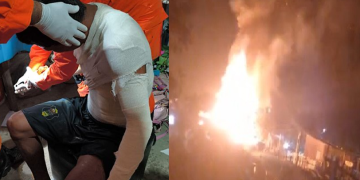 Por causa da botija de gás, homem fica com 30% do c0rp0 queimado em Manaus