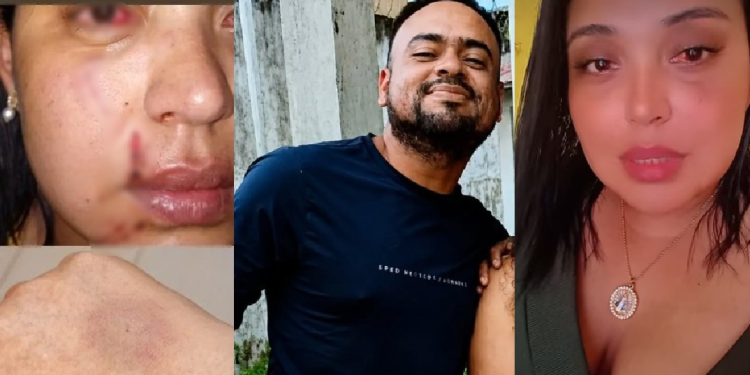 ‘Minha orelha quase e$tourou’, denuncia ex-Rainha do Guaraná agr3dida pelo ex após cr1se de ciúmes
