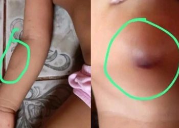 Família denuncia que menina de 3 anos voltou de creche com marcas de mordidas no Amazonas